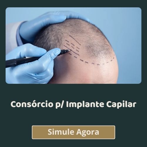 Consórcios para Implante Capilar em Natal RN