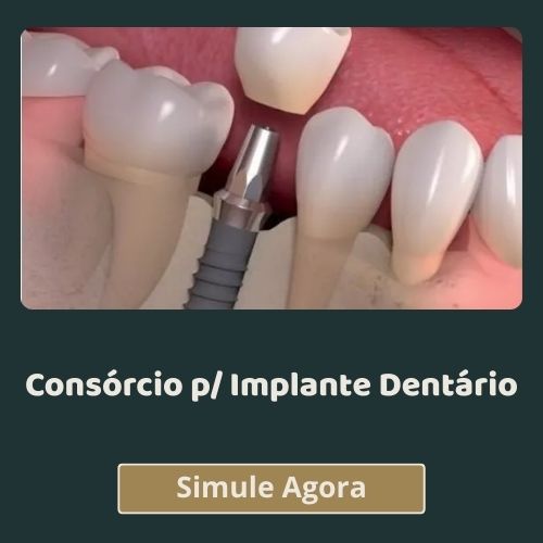 Consórcios para Implante Dentário em Natal RN